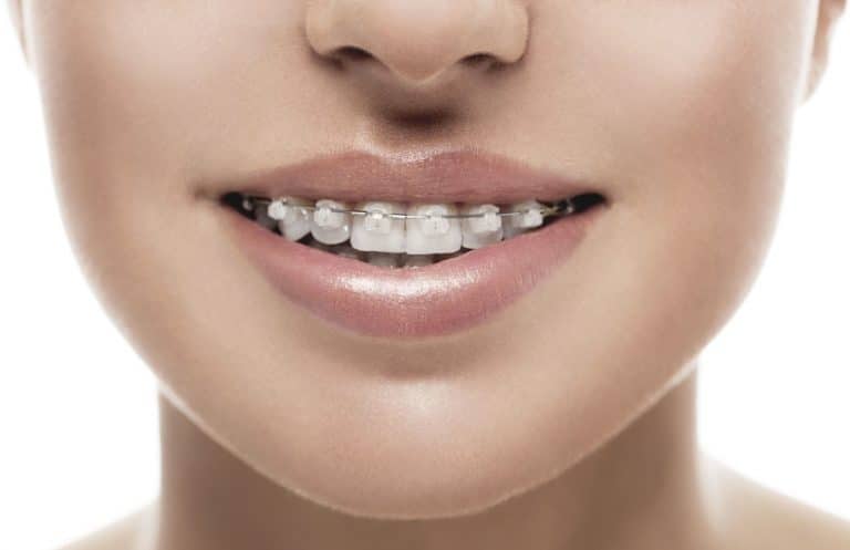 cost-of-braces-near-me-milestone-orthodontics