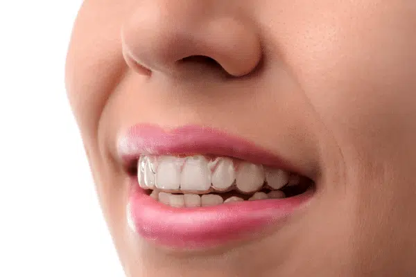How to Clean Your Invisalign Trays 